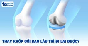 Thay khớp gối lâu dài, bác sĩ Trương Hữu Bảo điều trị chuyên sâu, phương pháp hiệu quả tại Tâm Anh Hospital.