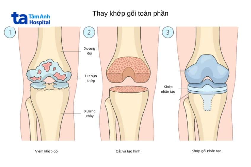 Thay khớp gối bao lâu thì đi lại được bình thường? Cần lưu ý gì? 3 Thay khớp gối bao lâu thì đi lại được bình thường? Cần lưu ý gì?