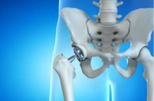 1. Phẫu thuật thay khớp háng tại phòng khám bác sĩ Trương Hữu Bảo.