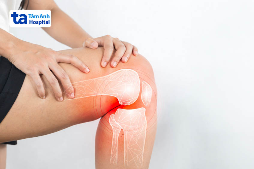Bệnh sưng khớp là gì? Nguyên nhân, triệu chứng và cách điều trị 3 Bệnh sưng khớp là gì? Nguyên nhân, triệu chứng và cách điều trị