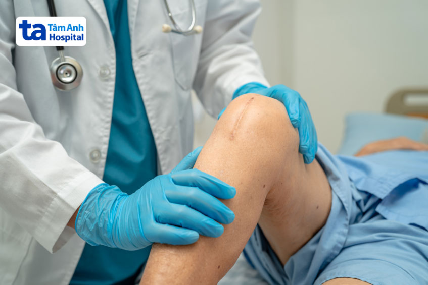 Viêm khớp gối ở người già: Nguyên nhân, dấu hiệu và điều trị 5 Viêm khớp gối ở người già: Nguyên nhân, dấu hiệu và điều trị