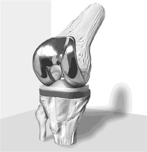 Ưu, nhược điểm của thay khớp gối nhân tạo: Có nên không? 2 Lưu nháp tự động