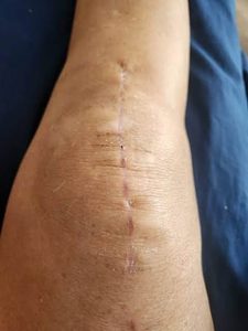 Ưu, nhược điểm của thay khớp gối nhân tạo: Có nên không? 1 Lưu nháp tự động