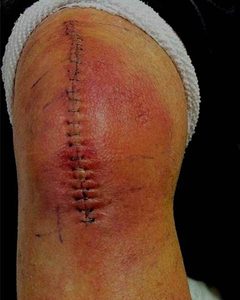 Biến chứng sau khi thay khớp gối có thể gặp phải 1 Lưu nháp tự động